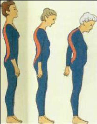 osteoporoza.jpg osteoporoza.jpg